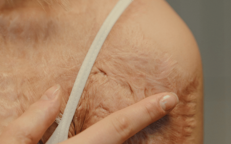 Skin Erosions The Physical Scarring