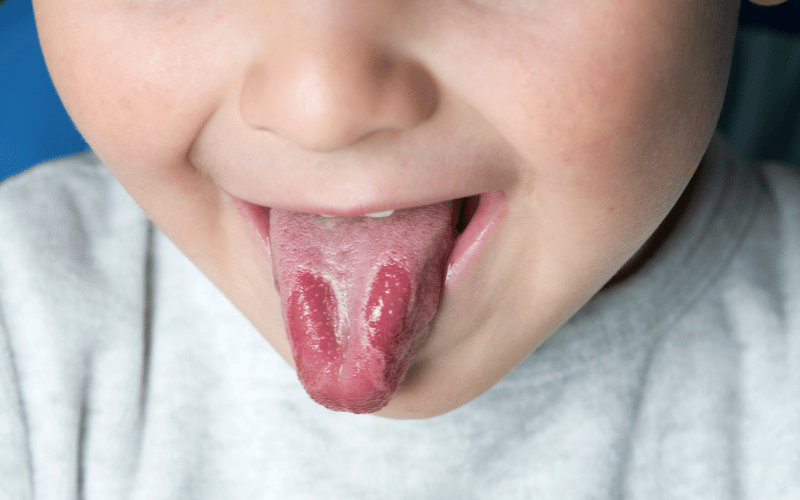 Smooth, Red Patches on the Tongue's Surface