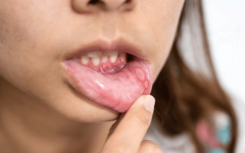 Sores in Your Mouth – A Painful Predicament