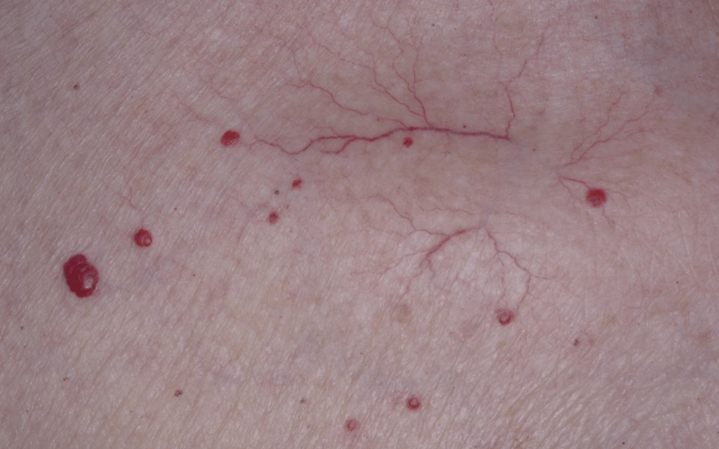 Spider Angiomas The Vascular Markers of Liver Disease