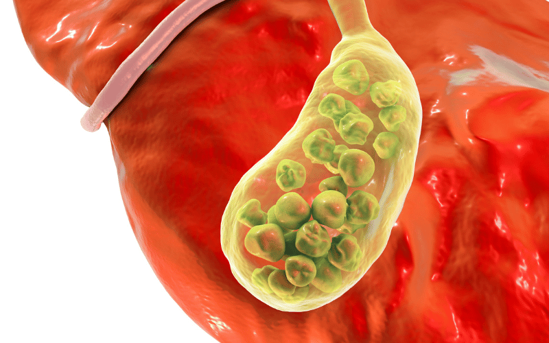 The Formation of Gallstones