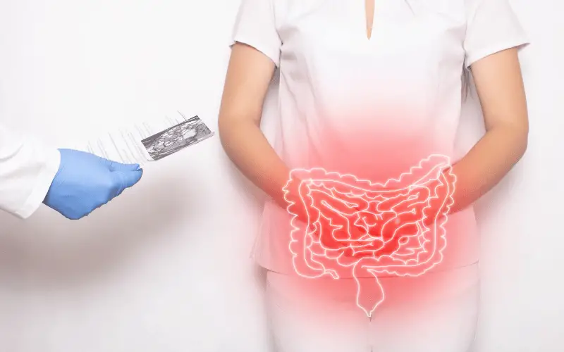 Top 10 Home Remedies for Diverticulosis Natural Ways to Boost Your Colon Health