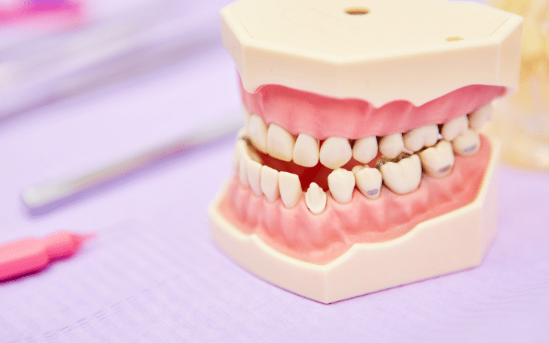 Types of Malocclusion