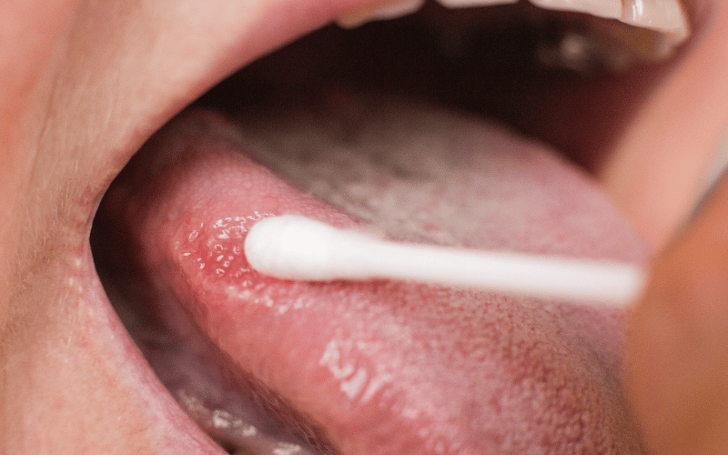 Understanding Hairy Leukoplakia The Top 10 Symptoms Everyone Should Recognize