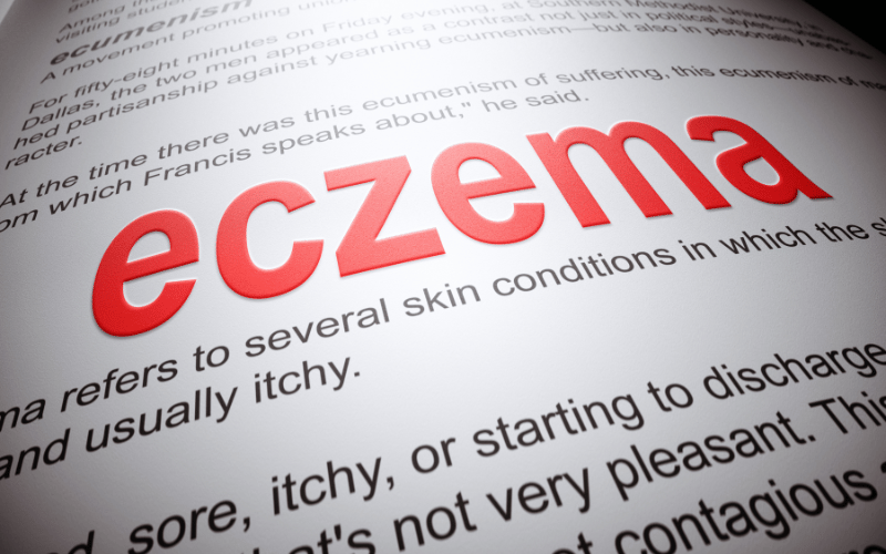 Unmasking Eczema Herpeticum