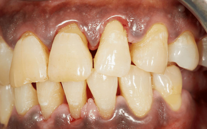 Unraveling the Mysteries of Gingivitis Top 10 Symptoms You Can’t Ignore