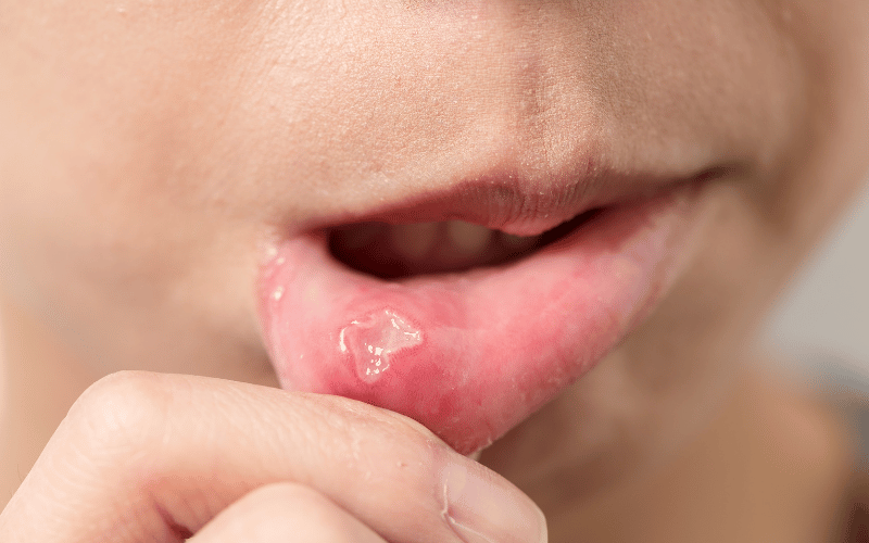 Unveiling the Silent Ode of Oral Ulcers