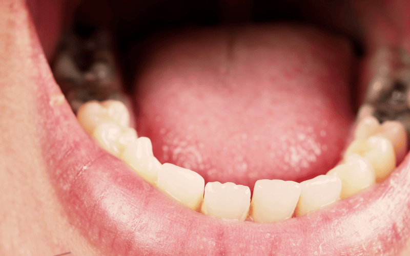 What Causes Tooth Decay