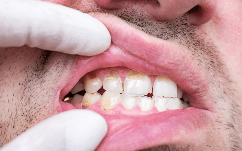 What is Malocclusion