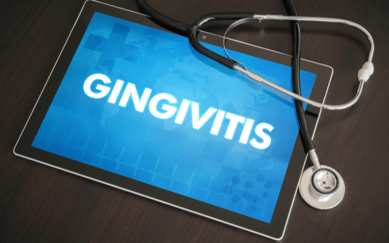 Gingivitis in Focus 15 Key Facts for a Healthy Mouth