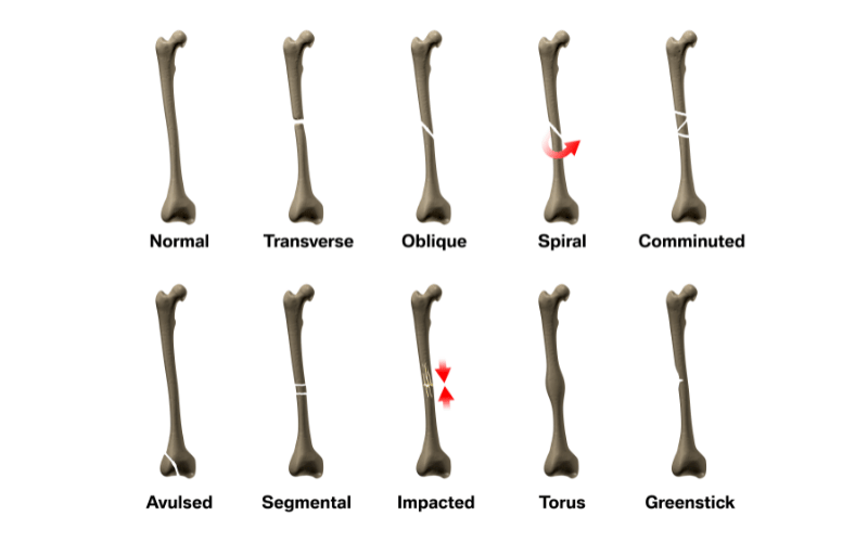 Greenstick Fractures Understanding This Common Childhood Injury