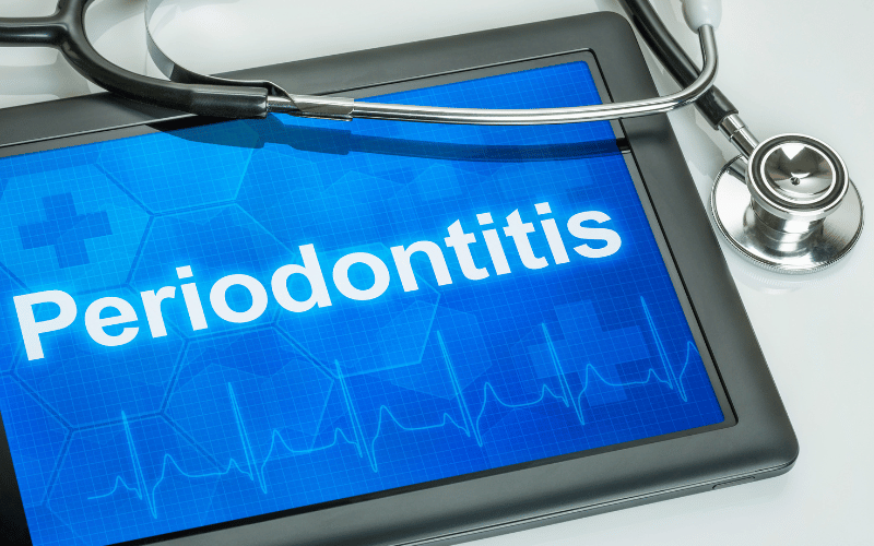 Periodontitis Knowing the Symptoms Can Save Your Smile