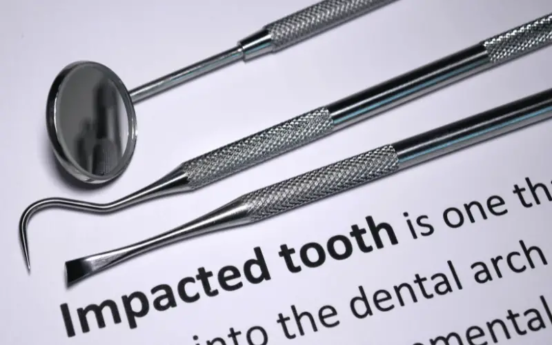 The Impact of Impacted Teeth on Dental Health 10 Key Facts