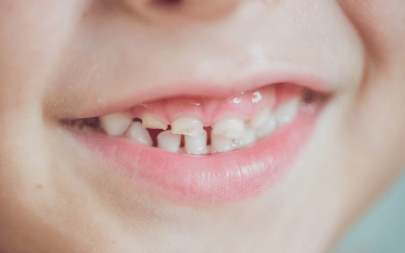 Tiny Teeth, Big Concerns The Reality of Early Childhood Caries