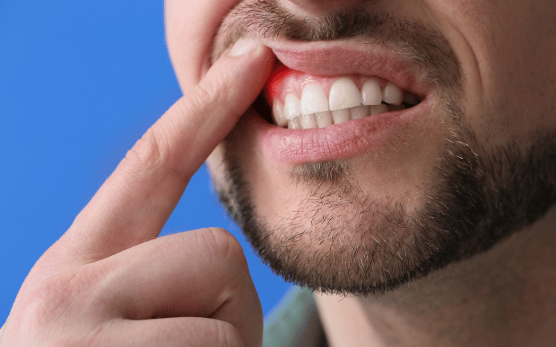 Swollen or Tender Gums The Silent Progression of Periodontitis