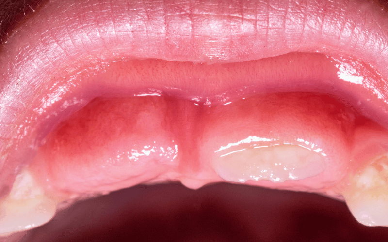 The Complexities of Delayed Tooth Eruption