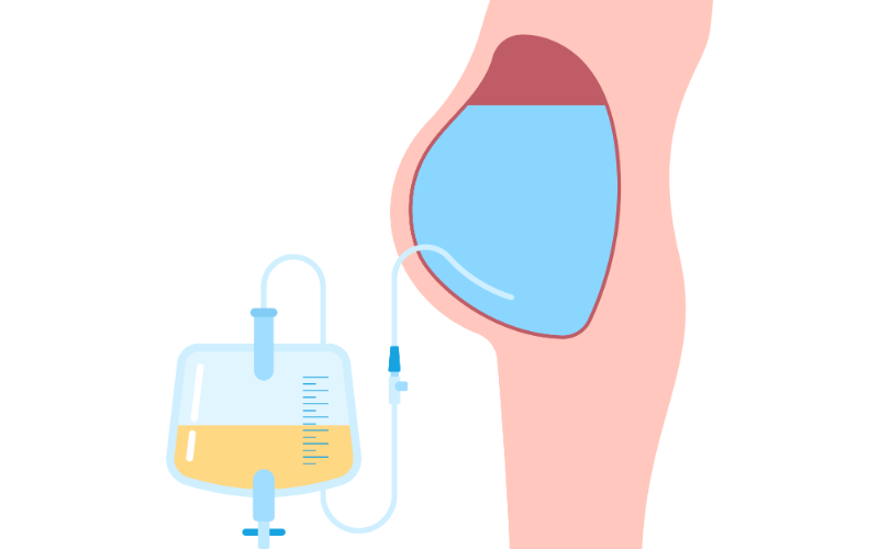 Ascites The Swelling Symphony of SBP