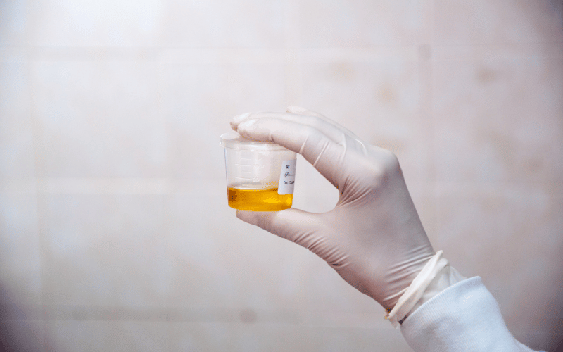 Decreased Urine Output A Subtle Yet Significant Indicator