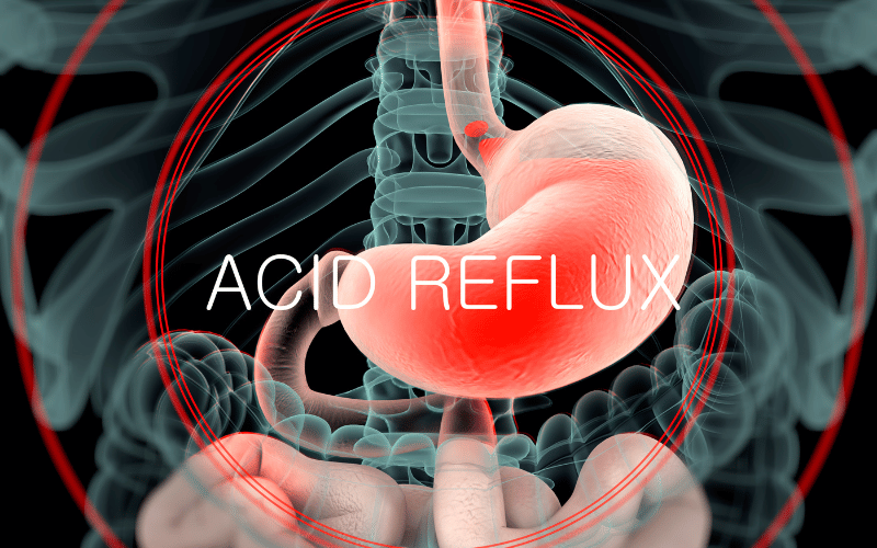 Heartburn and Acid Reflux The Discomforting Echo