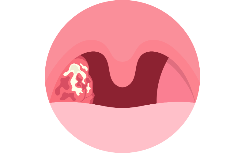 White or Yellow Coating on the Tonsils Decoding the Signs