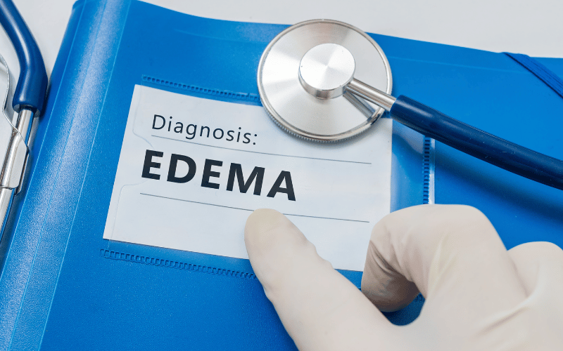 Peripheral Edema The Swelling Dilemma in HRS