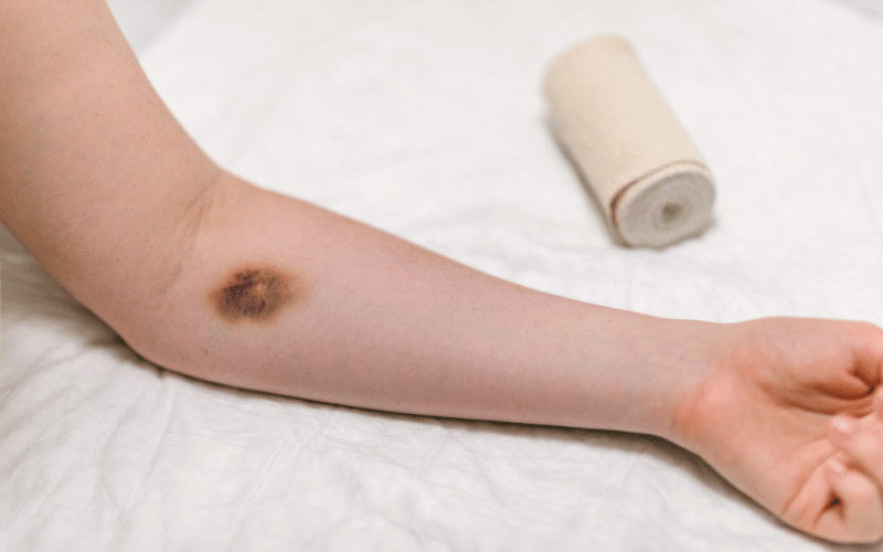 Easy Bruising and Bleeding The Clotting Challenges in Congestive Hepatopathy