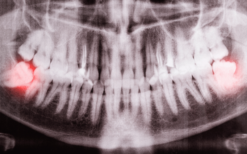 Impact of Impacted Teeth on Adjacent Teeth