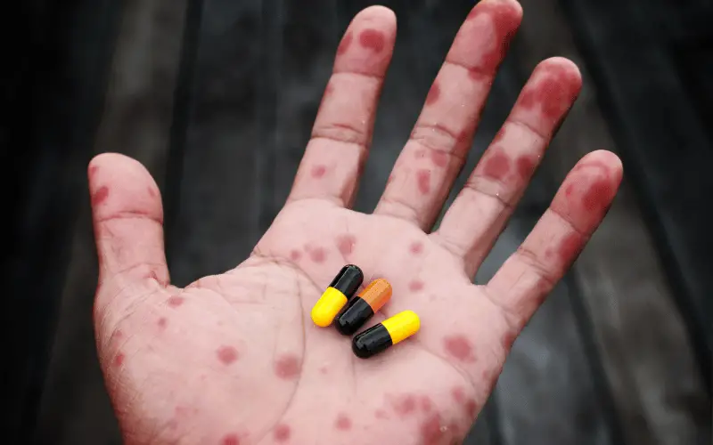 Antibiotics - The Primary Weapon Against Scarlet Fever