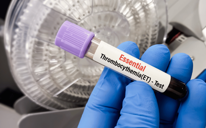 Diagnosis of Thrombocythemia Beyond Simple Blood Tests