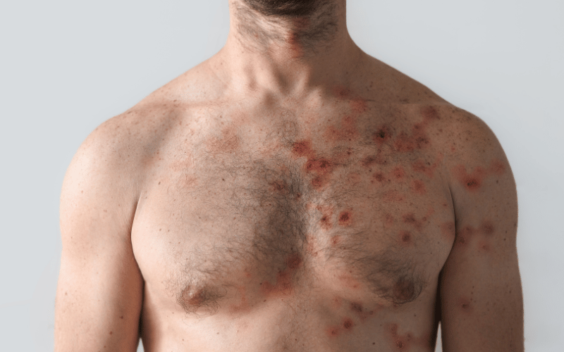 Distinctive Red Rash – Scarlet Fever's Signature