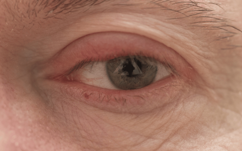 Eyelid Swelling - Visible Distress