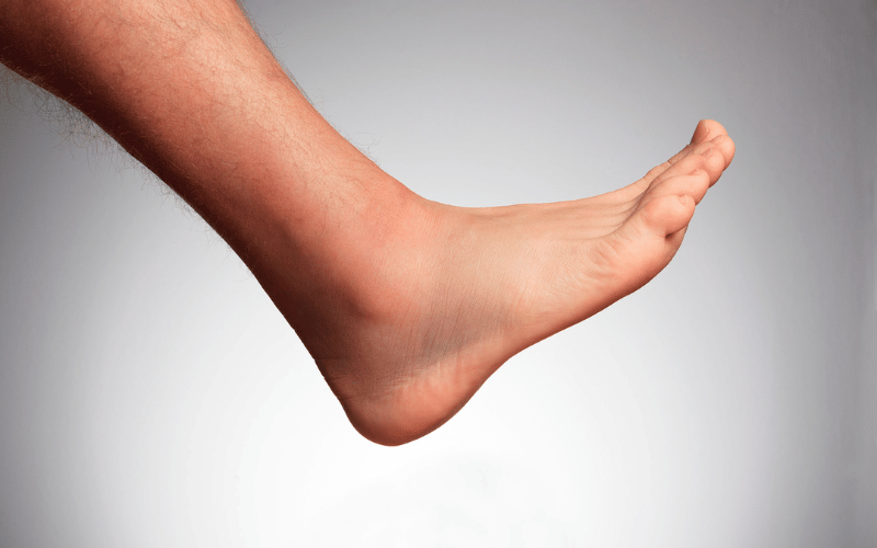 Foot Complications – Stepping Forward with Caution