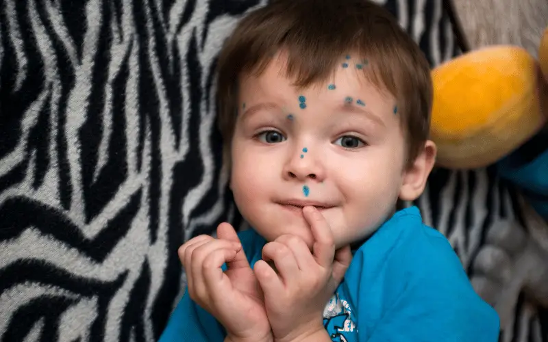 Navigating the Early Symptoms of Chickenpox