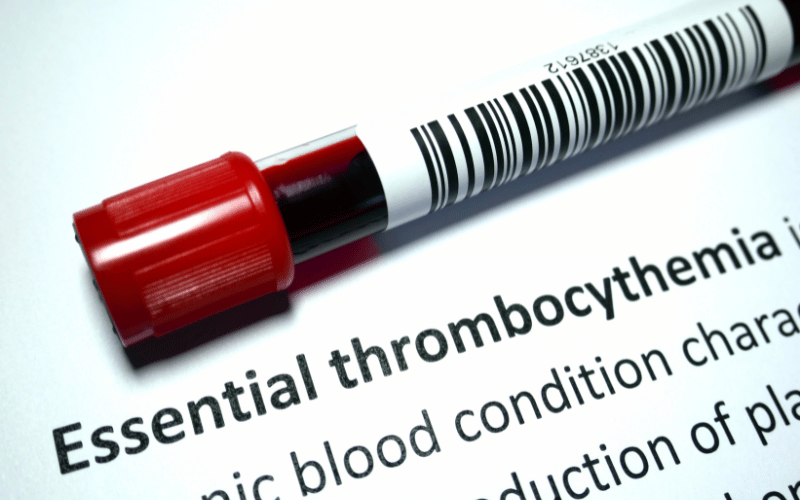 Navigating the Landscape of Essential Thrombocythemia