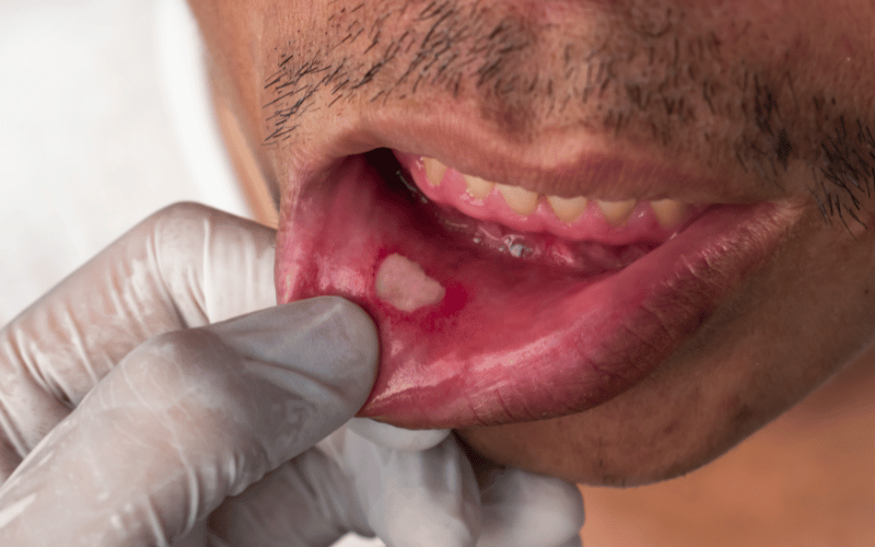 Oral Ulcers A Common Complaint in CyN