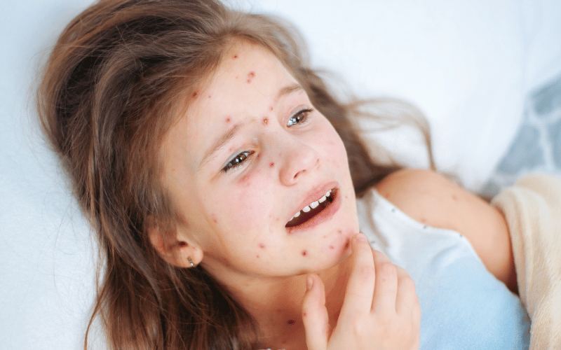 Rash The Hallmark of Chickenpox