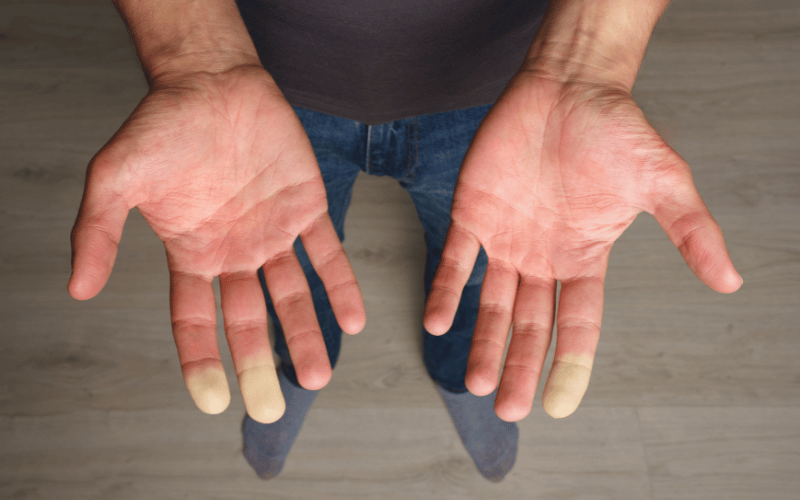 Raynaud's Phenomenon - The Cold's Tight Grip