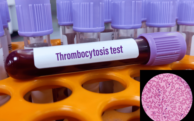 The Asymptomatic Nature of Thrombocythemia A Hidden Challenge