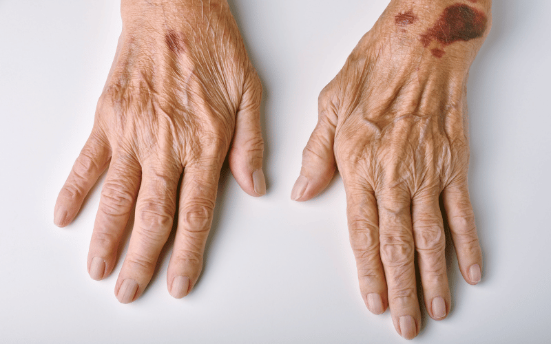 The Distinctive Skin Manifestations in Nonthrombocytopenic Purpura