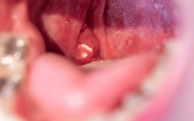 The Immune Role of Tonsils