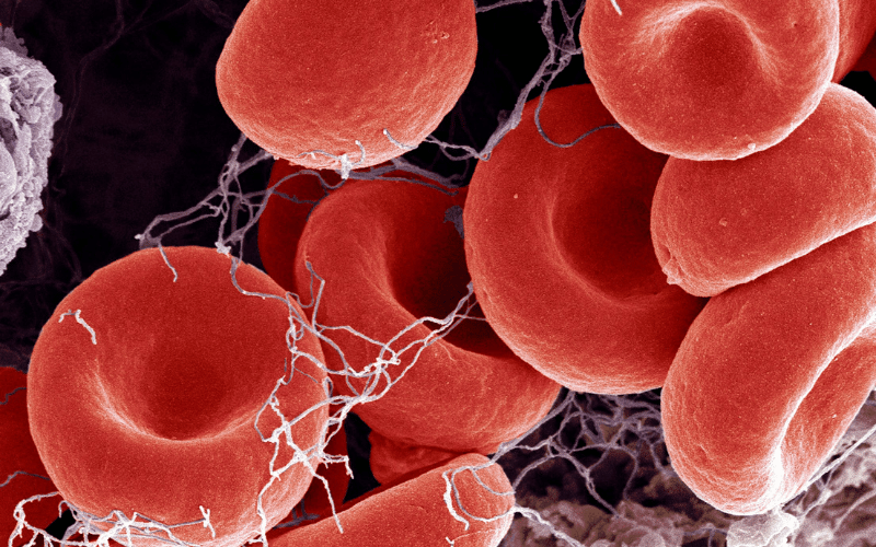 The Threat of Thrombosis Understanding Clot Risks in PV