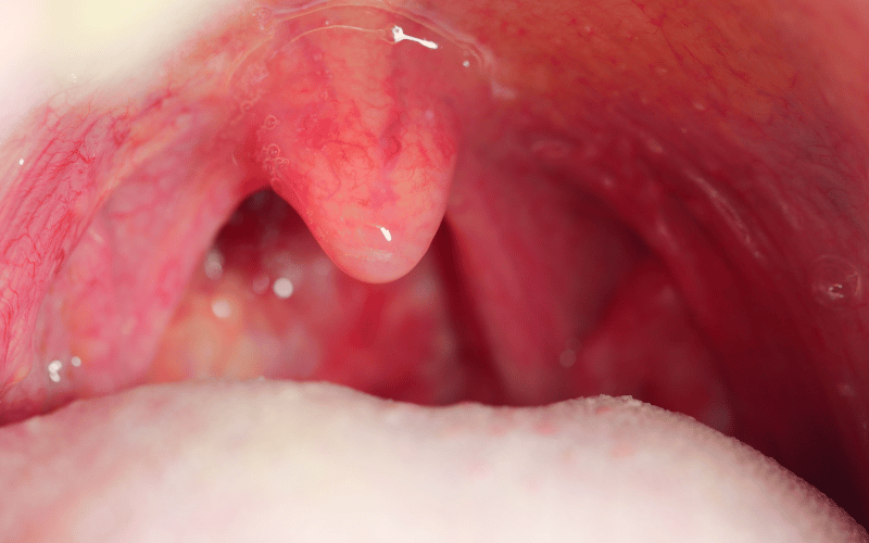 Tonsil Stones