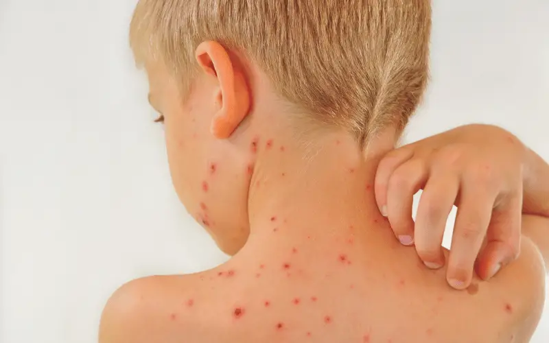 Understanding Chickenpox in Adults A Comprehensive Overview