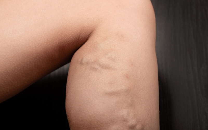 Vein Visibility – An Indicator of DVT